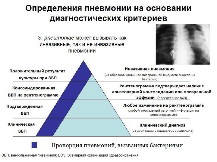 Определения пневмонии на основании диагностических критериев 